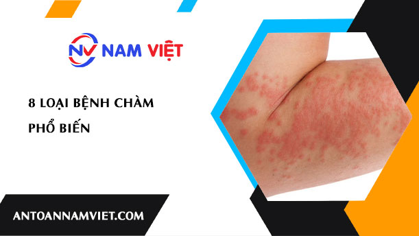 8 LOẠI BỆNH CHÀM PHỔ BIẾN