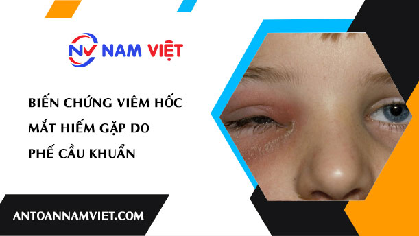 BIẾN CHỨNG VIÊM HỐC MẮT HIẾM GẶP DO PHẾ CẦU KHUẨN