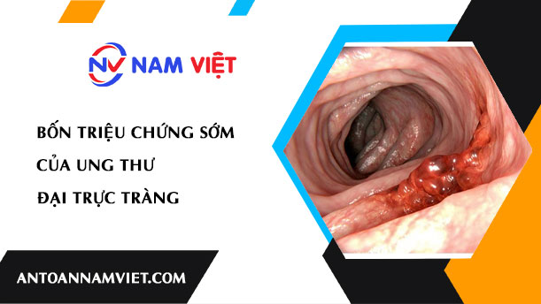 BỐN TRIỆU CHỨNG SỚM CỦA UNG THƯ ĐẠI TRỰC TRÀNG