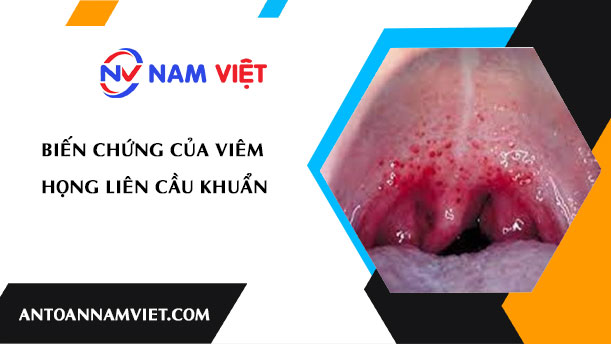 Biến chứng của viêm họng liên cầu khuẩn