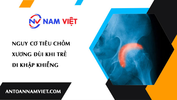NGUY CƠ TIÊU CHỎM XƯƠNG ĐÙI KHI TRẺ ĐI KHẬP KHIỄNG