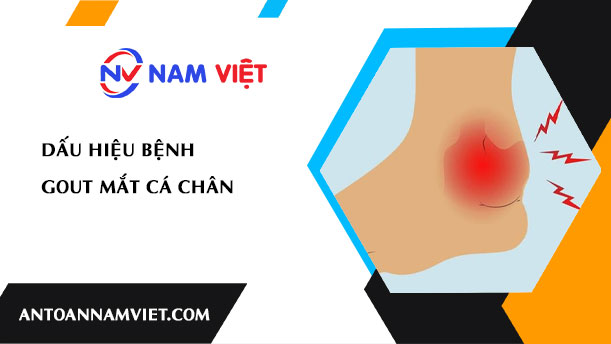 Dấu hiệu bệnh gout mắt cá chân