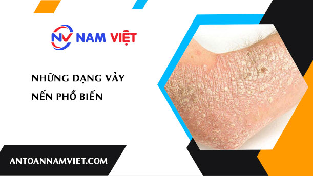 NHỮNG DẠNG VẢY NẾN PHỔ BIẾN