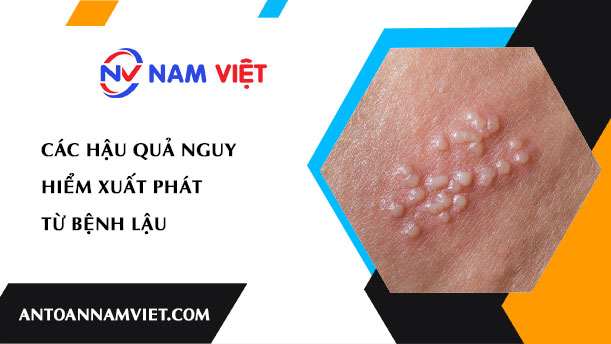 CÁC HẬU QUẢ NGUY HIỂM XUẤT PHÁT TỪ BỆNH LẬU