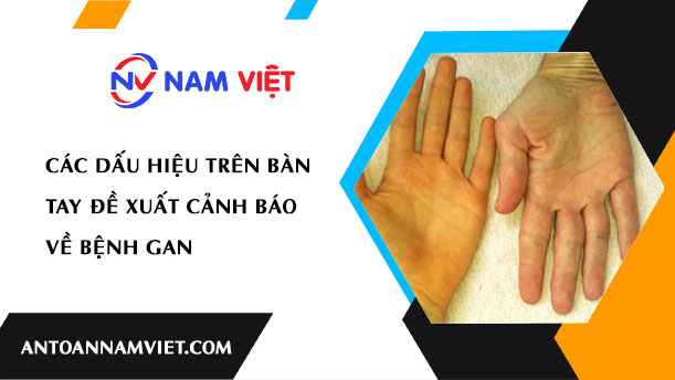 Các Dấu Hiệu Trên Bàn Tay Đề Xuất Cảnh Báo Về Bệnh Gan