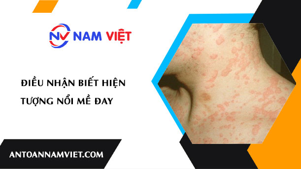 ĐIỀU NHẬN BIẾT HIỆN TƯỢNG NỔI MỀ ĐAY