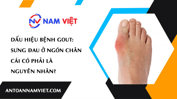 Dấu Hiệu Bệnh Gout: Sưng Đau Ở Ngón Chân Cái Có Phải Là Nguyên Nhân?