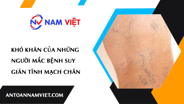 KHÓ KHĂN CỦA NHỮNG NGƯỜI MẮC BỆNH SUY GIÃN TĨNH MẠCH CHÂN