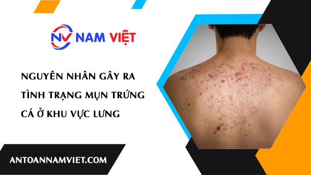 NGUYÊN NHÂN GÂY RA TÌNH TRẠNG MỤN TRỨNG CÁ Ở KHU VỰC LƯNG