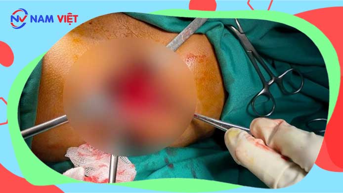 Man saved after being pierced longitudinally by a crowbar. Photo: Vietnam - Cuba Friendship Hospital, Dong Hoi