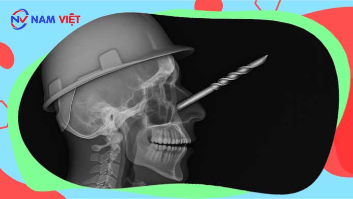 Male worker in critical condition after rock drill bit pierces nasal cavity