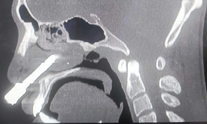 Male worker with rock drill bit piercing nasal cavity in critical condition